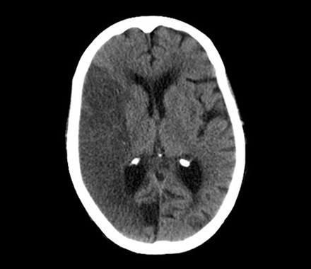 Role of CT and MRI in Neurological Emergencies