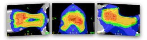 Advanced Radiotherapy