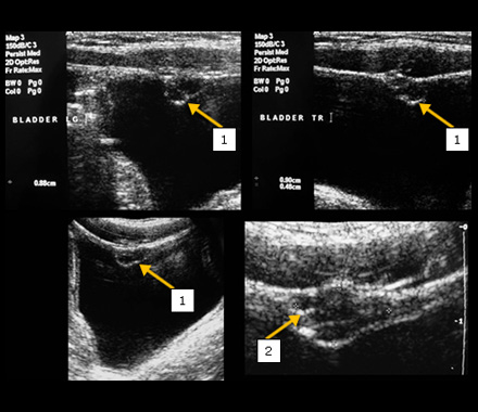 Abnormalities of the Bladder and Urethra