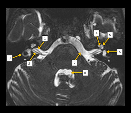 Vestibular_Schwannomas